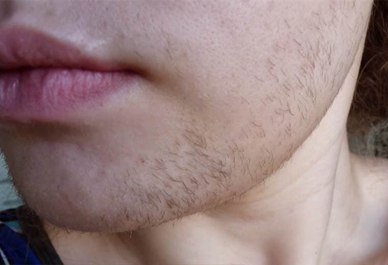 Causas y consecuencias del exceso de andrógenos en las mujeres 